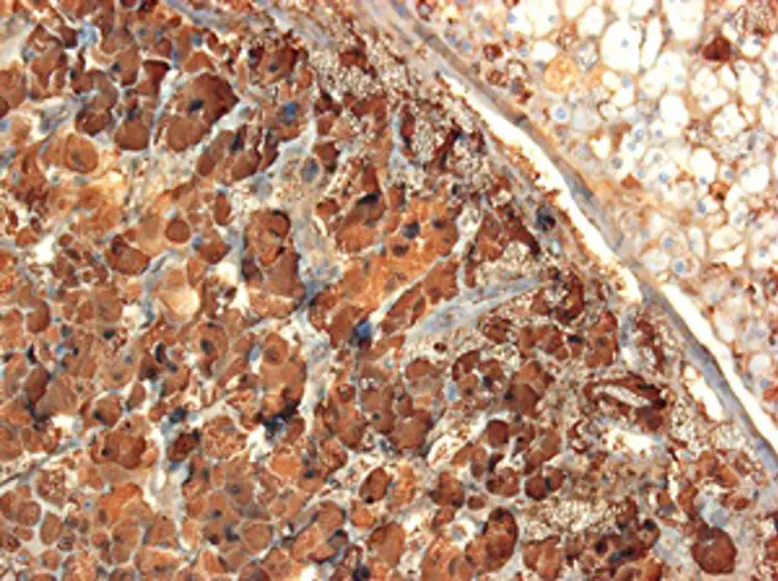 Light micrograph of a section through a phaeochromocytoma tumour of the <a tabindex='0' class='popover-dismiss' href='/glands/adrenal-glands/' data-target-type='infoSheet' data-target-url='/glands/adrenal-glands/' data-bs-toggle='popover' data-bs-trigger='focus' title='adrenal gland' data-bs-content='1443' >adrenal gland</a>. At left in the <a tabindex='0' class='popover-dismiss' href='/glossary/m#medulla' data-target-type='glossary' data-target-url='/glossary/m#medulla' data-bs-toggle='popover' data-bs-trigger='focus' title='medulla' data-bs-content='1845' >medulla</a>, large tumour cells are seen arranged in cords or small masses marked by chromogranin A (blue); at upper right the normal adrenal cortex is seen.